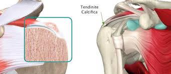Schema tendinopatia calcifica nella spalla