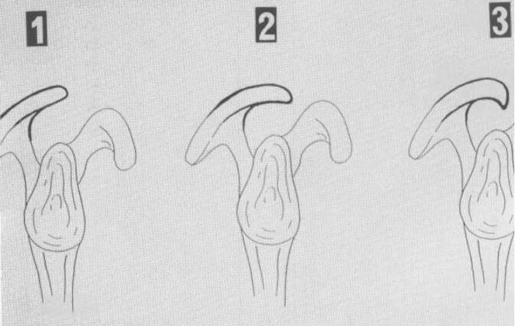 acromion piatto, curvo e uncinato